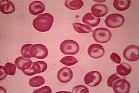 Image result for thalassemia cells