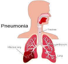 Terjadinya Penyakit Pneumonia