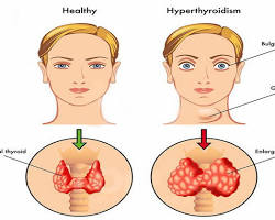 Hipertiroidi resmi