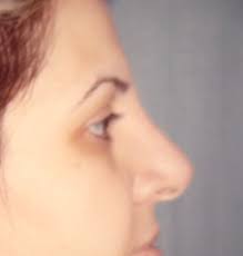 ... Plastic Surgery Egypt Dr. Adel Wilson liposuction tip nose job bariatric. Rhinoplasty: Dorsal Hump, Tip, Wide Ala Nasi and Nasal Deviation Correction: ... - dibane_imane_103_b_post_-_Copy.104232514_std