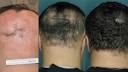 Traitement contre l alopecie