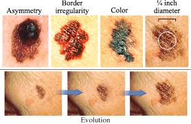 Image result for skin cancer