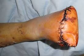 Image result for diabetic foot amputation