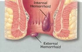 Hemoroid (Wasir / Ambien)