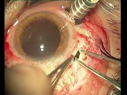 Image result for foreign body in eye