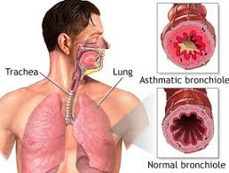 Tanda-Tanda Penyakit Bronkitis