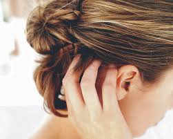 Image result for irritated scalp