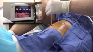 Image result for arthritis treatment with radiofrequency