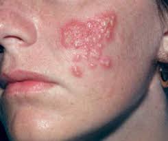 Znalezione obrazy dla zapytania herpes simplex 1
