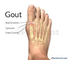Image result for IMAGES FOR GOUT