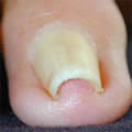 Resultado de imagen de uña  dedo en teja