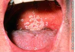 Image result for candida albicans