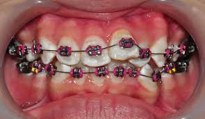 Image result for orthodontic treatment