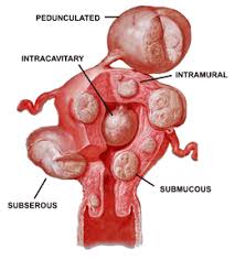 Image result for fibroid tumor