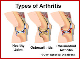 Image result for arthritis