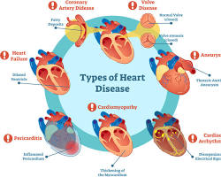 Image of Cardiovascular diseases