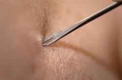 bifurcated needle