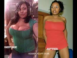 Image result for obesity photos before and after