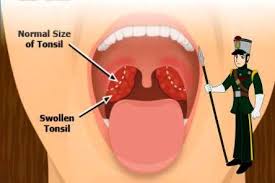 Image result for tonsillitis