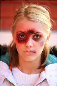 Coco (Andreea Patrascu) se alege cu rani severe pe fata, iar Cici (Adina Galupa) risca sa ramana paralizata. - andreea-patrascu-accident