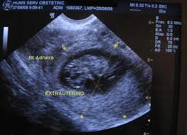 Resultado de imagen para embarazo ectopico DIAGNOSTICO