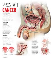 Image result for Men's prostate Cancer