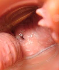 Age 25 Entire Cycle Beautiful Cervix Project