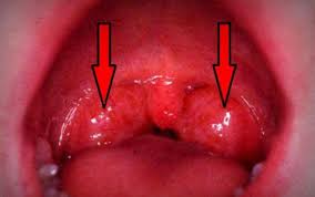 Image result for apa itu tonsil