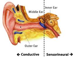 Hearing Loss (Hilang Pendengaran)