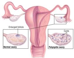 Image result for CAUSES OF INFERTILITY IN WOMEN