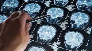 Image result for Diabetes Drug May Help Prevent Second Stroke