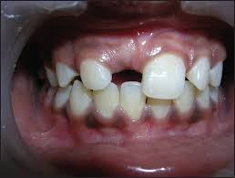 Image result for crowding due to supernumerary teeth