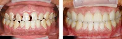 Kết quả hình ảnh cho trước - sau bọc răng sứ