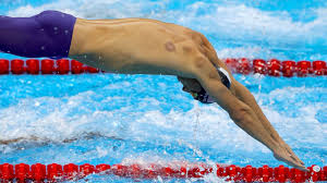 Image result for cupping