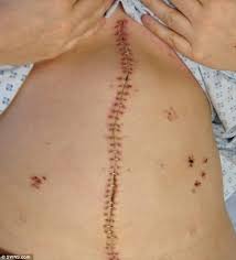 Image result for kidney surgery         girl
