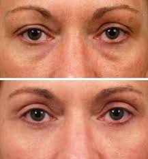 Blepharoplasty cairo egypt cosmetic surgery plastic Dr Adel Wilson. Upper and Lower Eyelid Surgery: This 61 year old woman desired eyelid rejuvenation to ... - 7.9244649_std