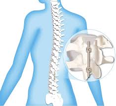 Spinal Devices Market Challenges, Analysis and Forecast to 2032