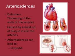 Image result for arteriosclerosis/atherosclerosis