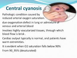 Image result for cyanosis