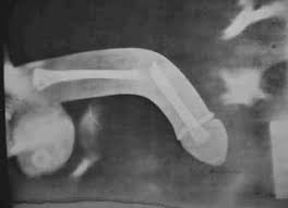Résultat de recherche d'images pour "penile radiology"