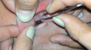 Image result for cockroach in ear