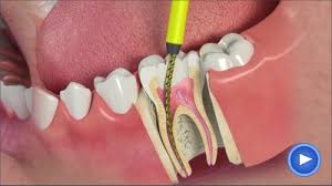 Image result for root canal