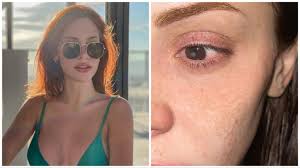 "Warning to Contact Lens Wearers: TikTok Star Suffers from Flesh-Eating Parasite that Causes Blindness"