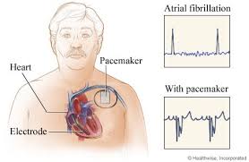 Image result for pacemaker
