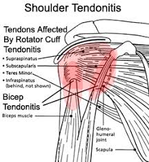 Image result for tendonitis