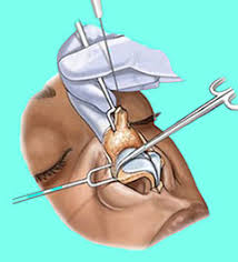 Resultado de imagem para imagem cirurgia rinoplastia