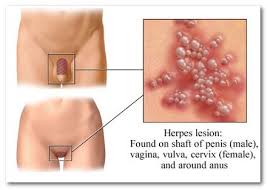 Image result for herpes virus pictures