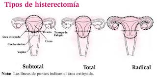 Resultado de imagem para histerectomia