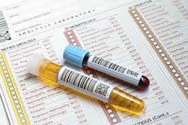 Image result for Seeing blood in your urine