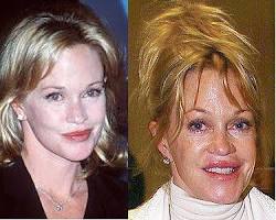 Imagen de Melanie Griffith before and after plastic surgery